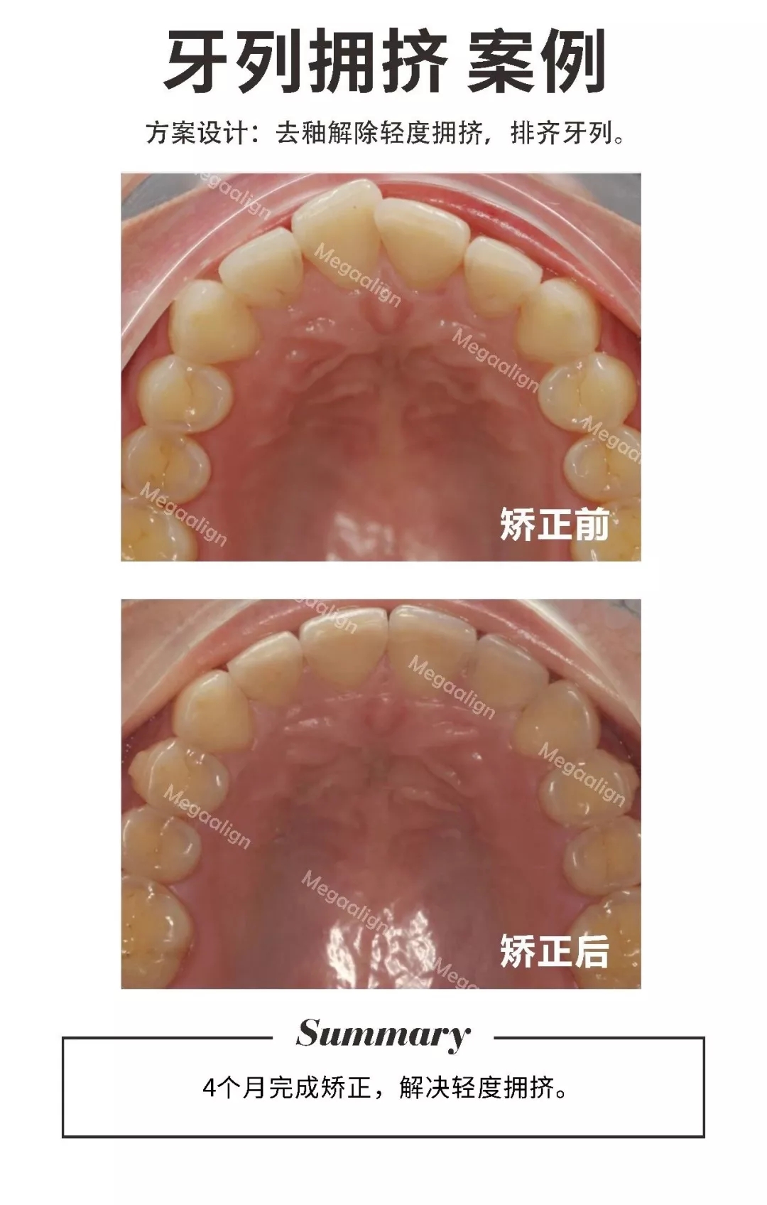 牙列拥挤-隐形矫正案例