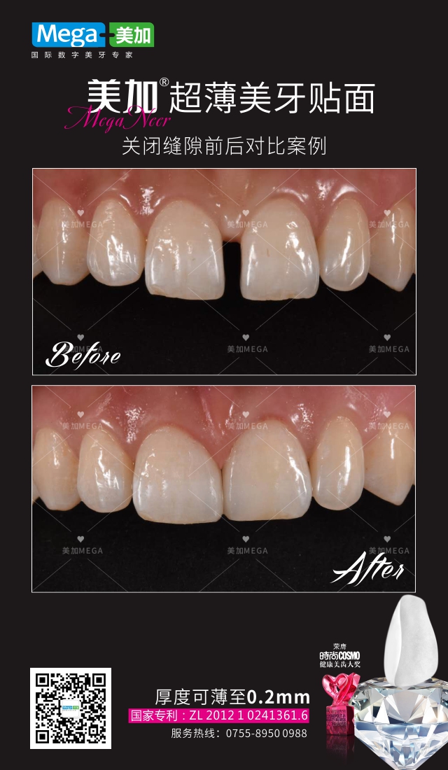 关闭牙缝-贴面案例