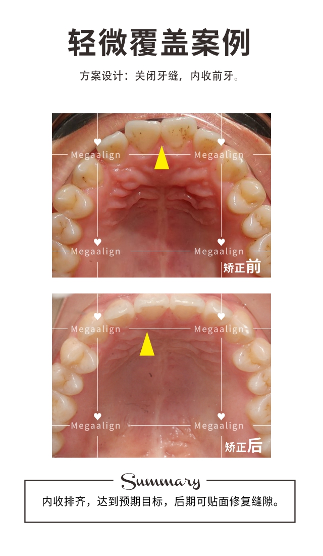 解决轻微覆盖-易齐微矫案例