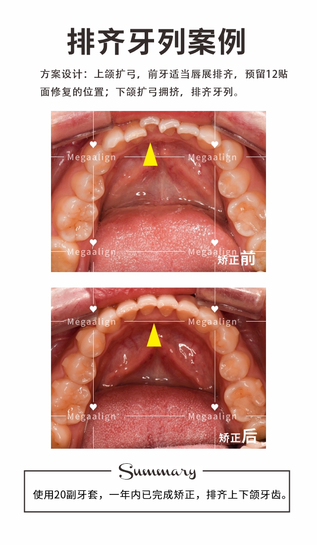 排齐牙列-易齐微矫案例