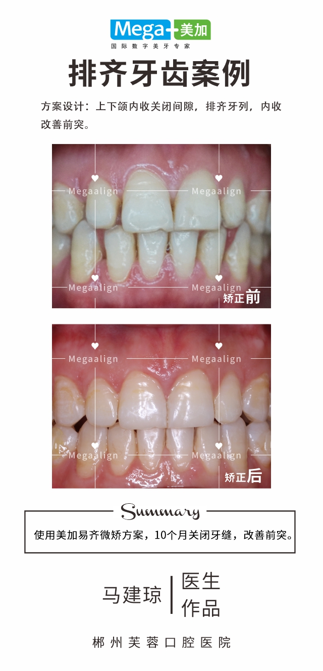 排齐牙齿-易齐矫正案例