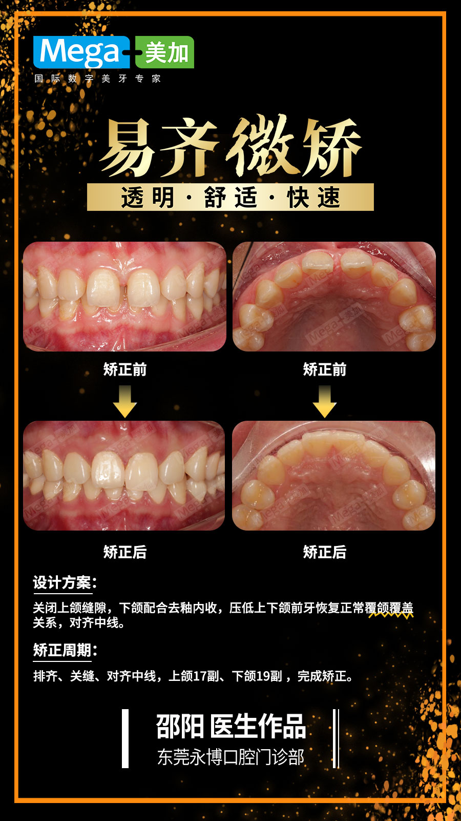 关闭牙缝-易齐微矫案例