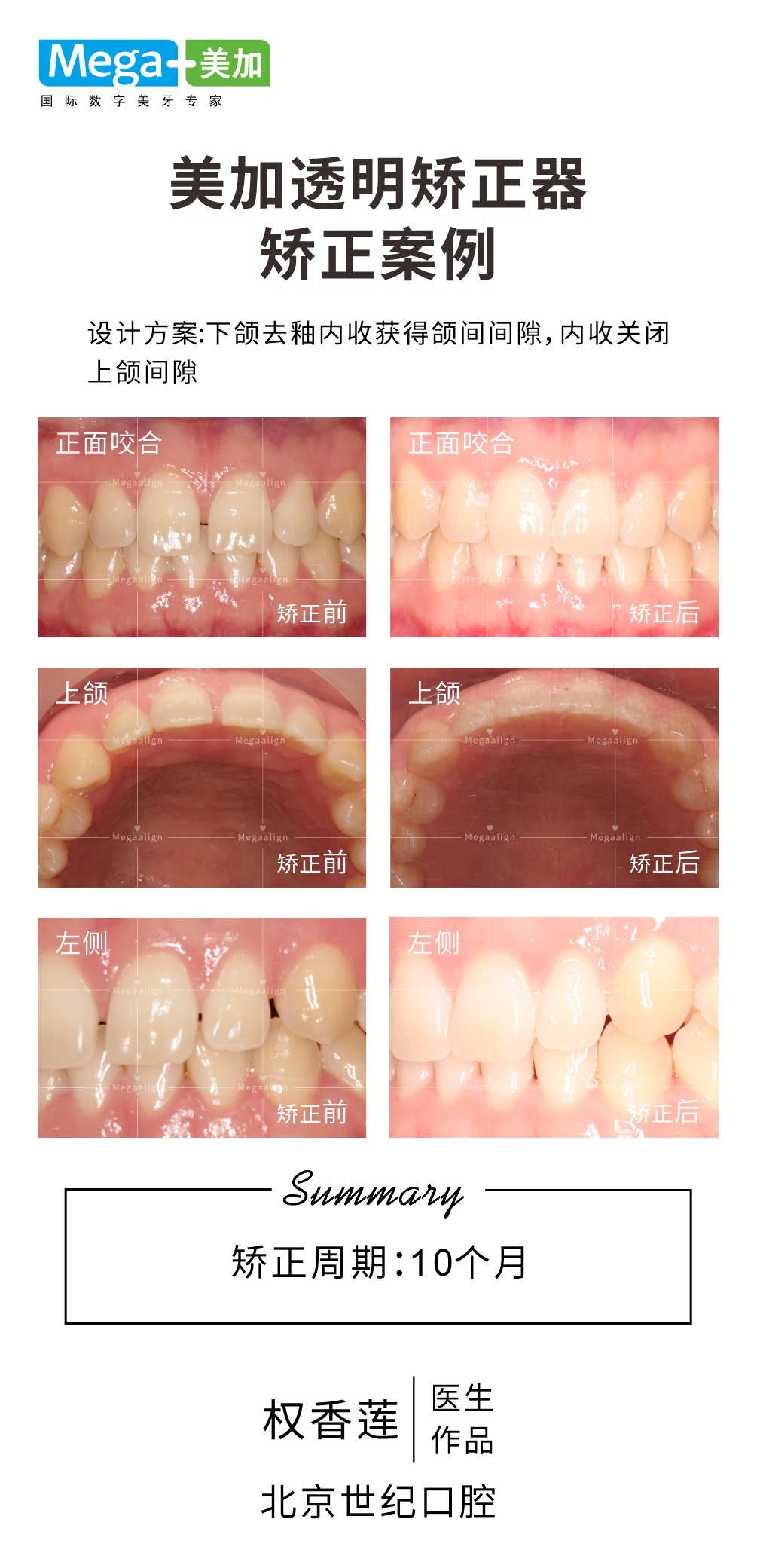 关闭间隙-矫正案例