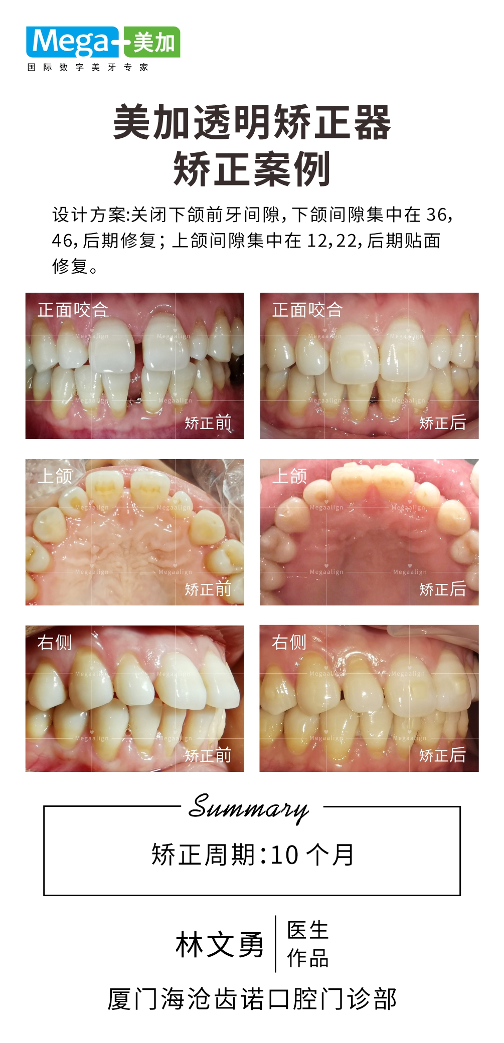 关闭前牙间隙-矫正案例