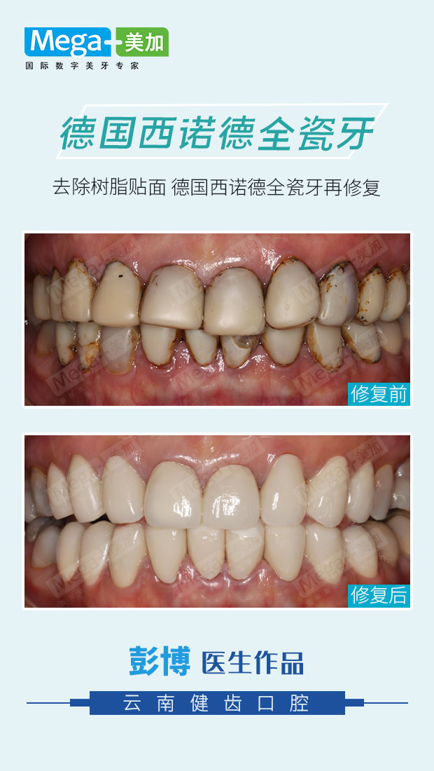 西诺德全瓷牙修复案例