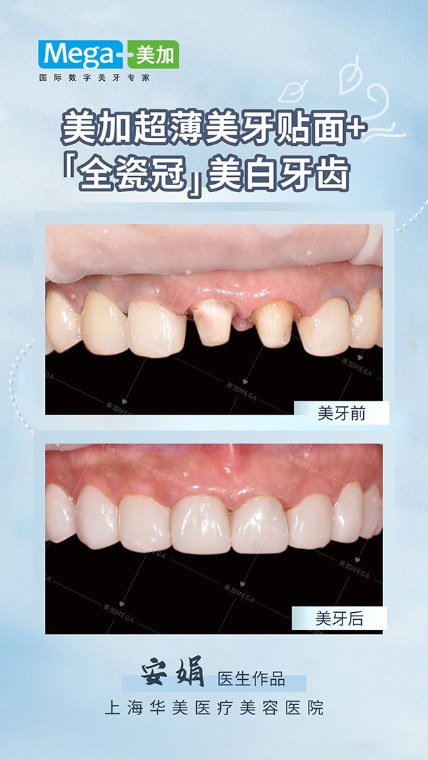 美加全瓷冠美牙案例