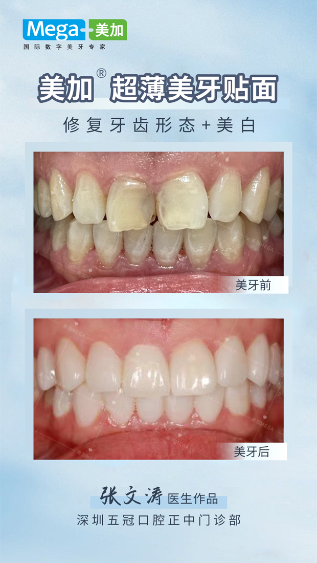 修复牙齿形态-贴面案例