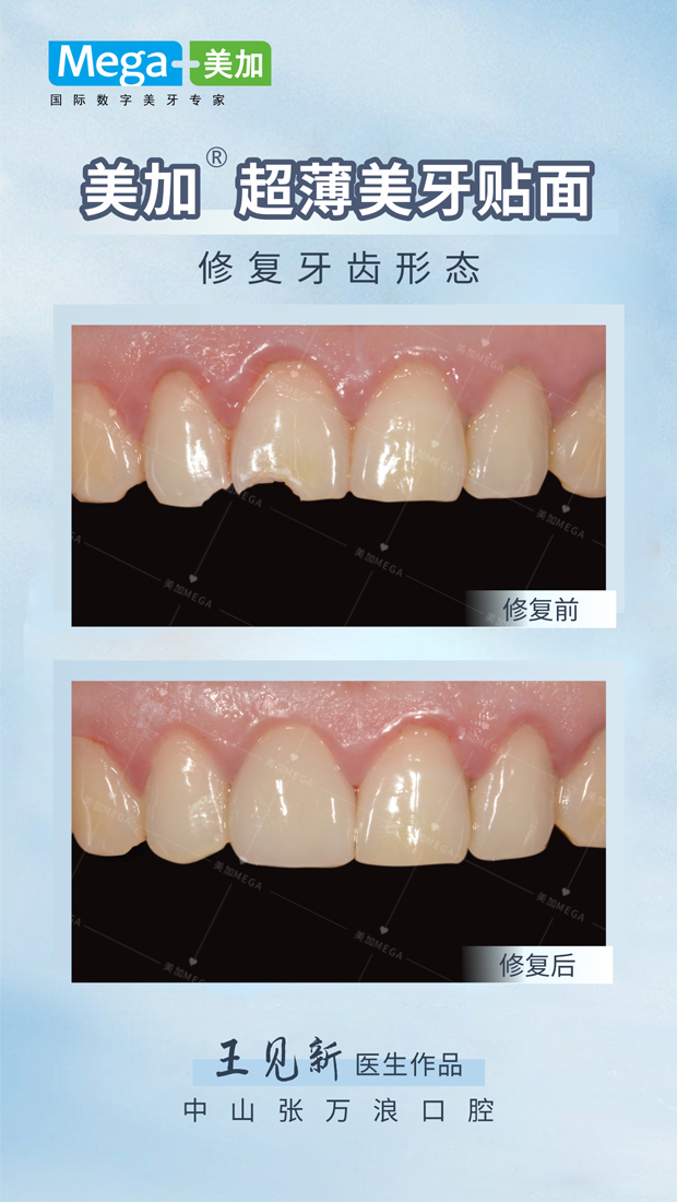 修复牙齿形态-贴面案例