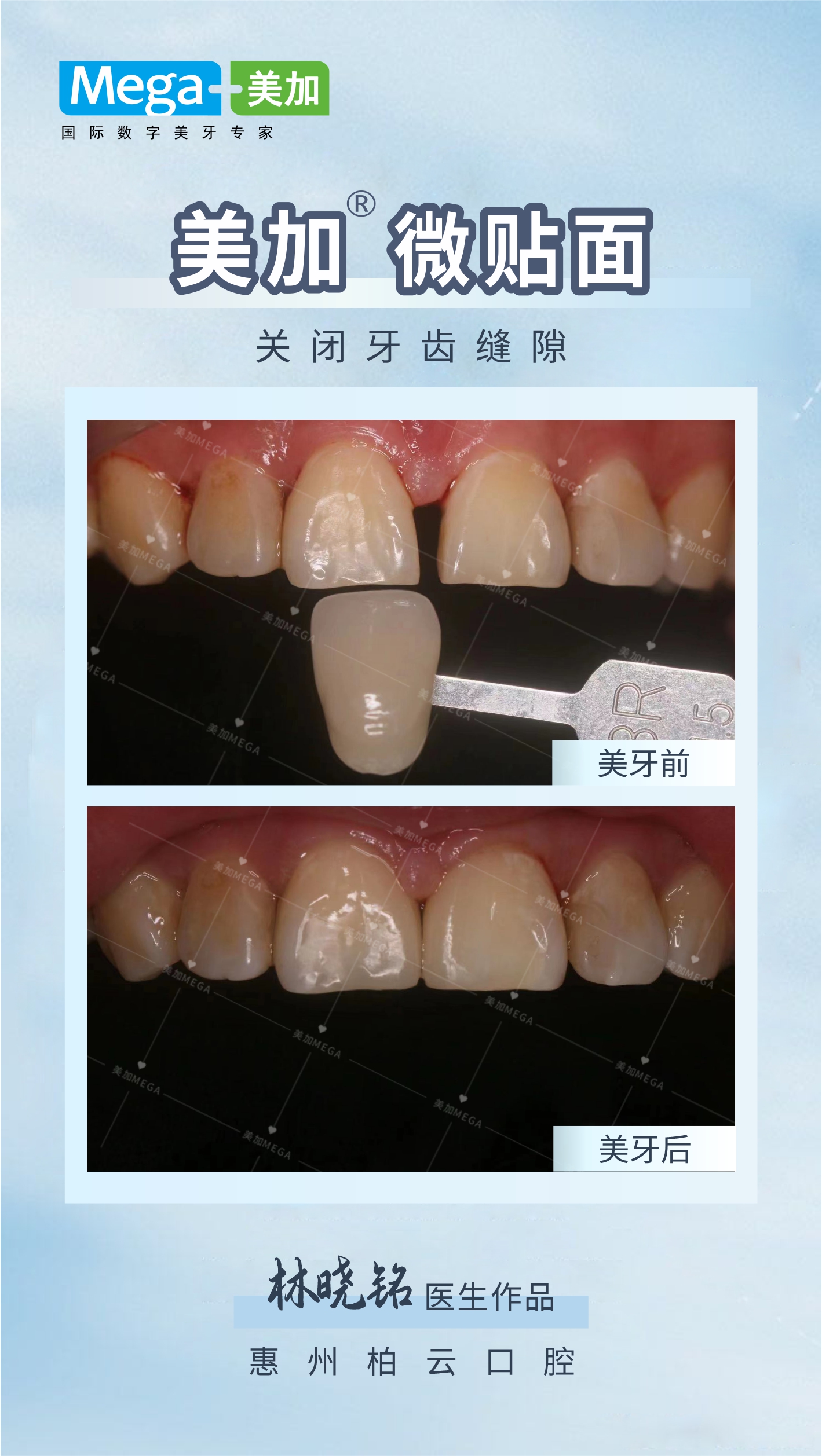 美加微贴面-关闭牙齿缝隙-惠州