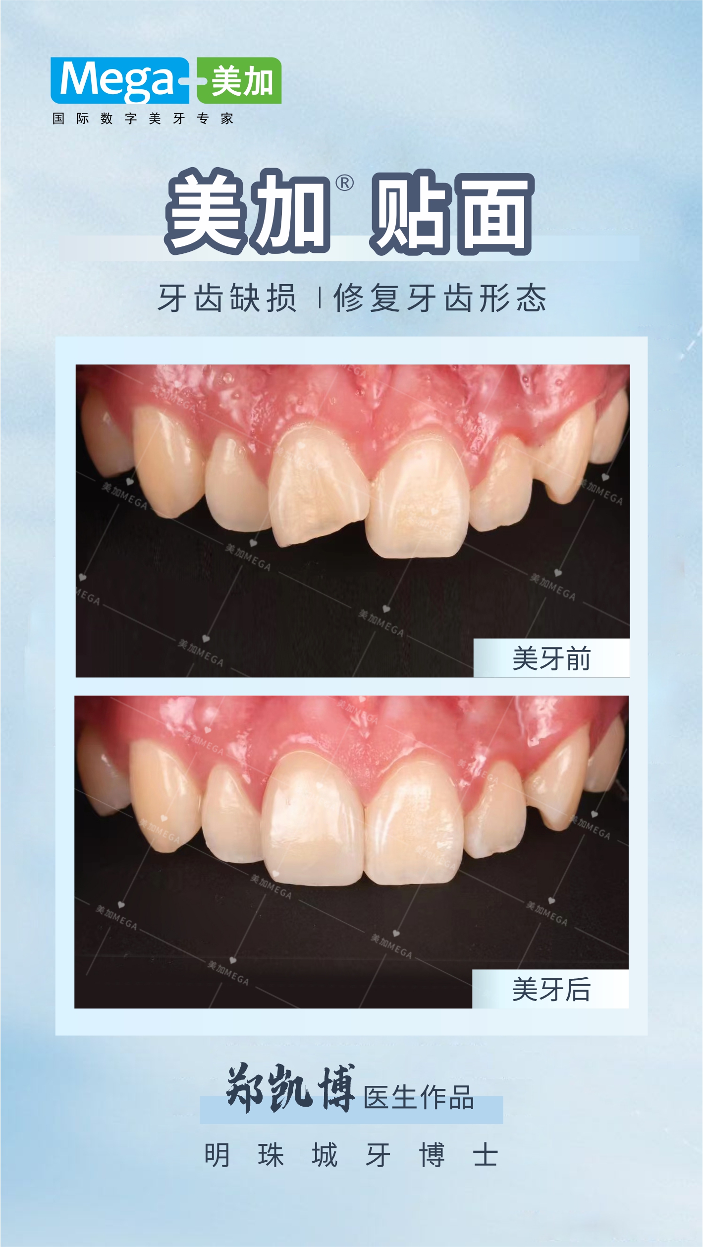 美加贴面-修复缺损牙