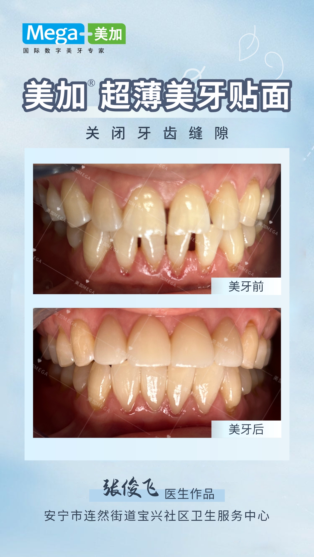 美加超薄贴面-关闭牙齿缝隙