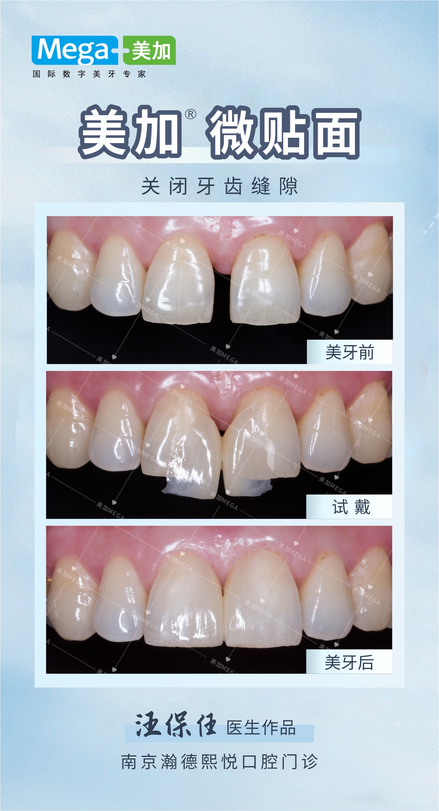 美加微贴面-关闭牙缝