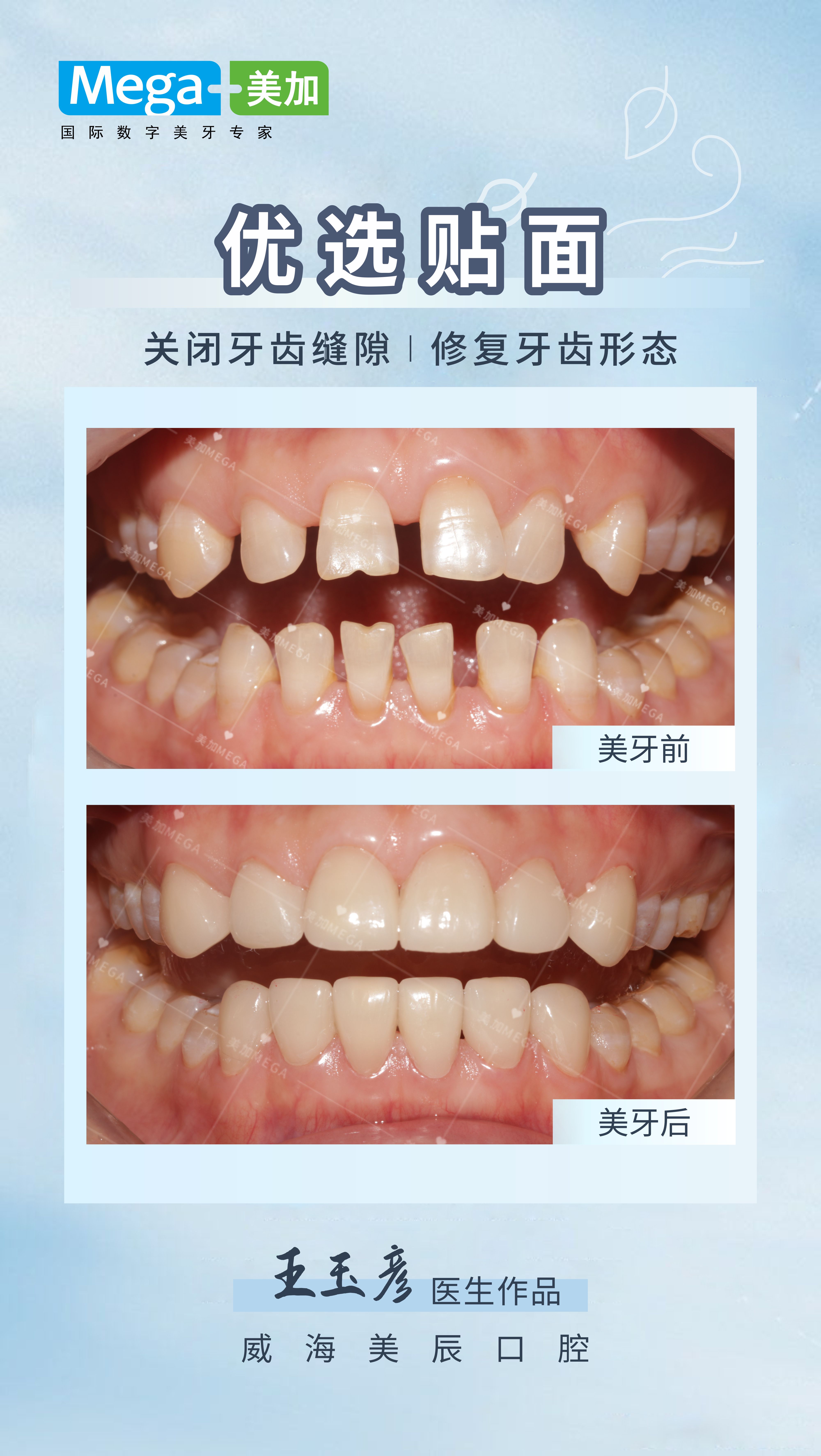 优选贴面-关闭牙齿缝隙 修复牙齿形态