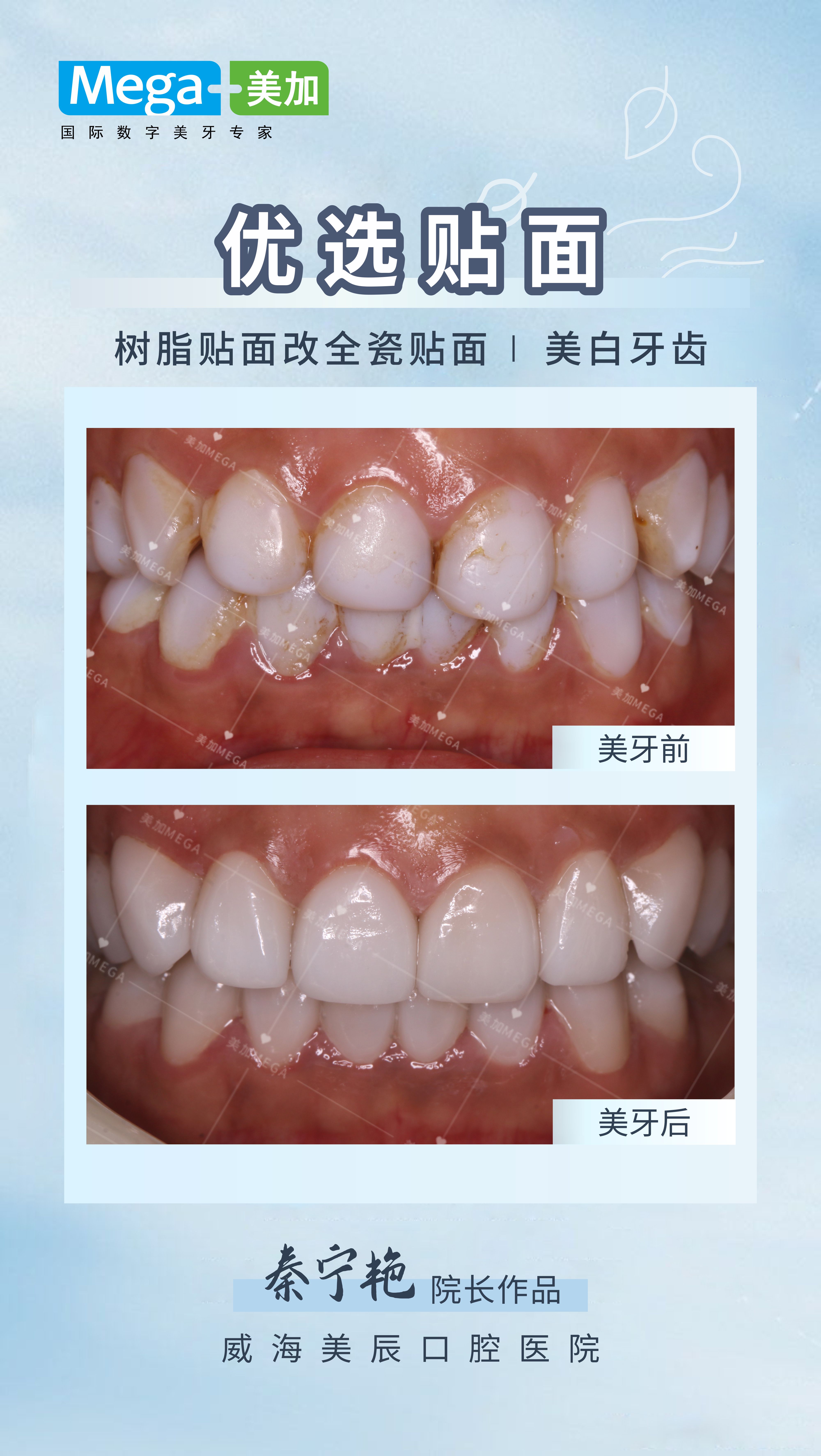 优选贴面 - 树脂贴面改全瓷贴面 美白牙齿