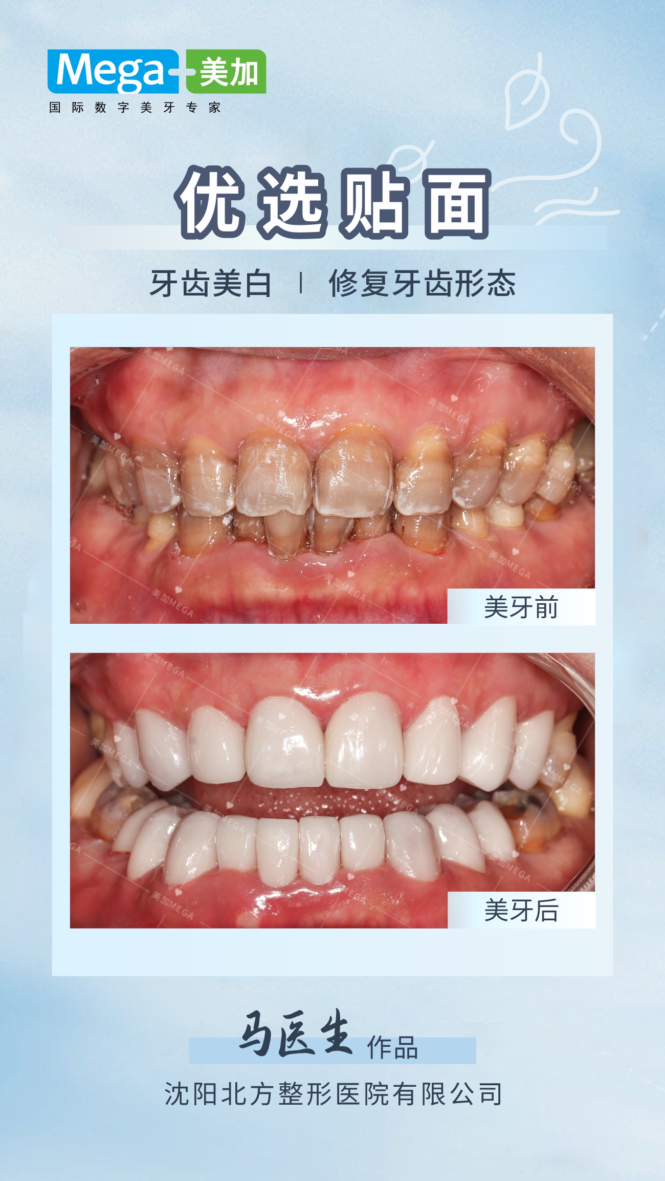 优选贴面 - 牙齿改色  牙齿美白 四环素牙