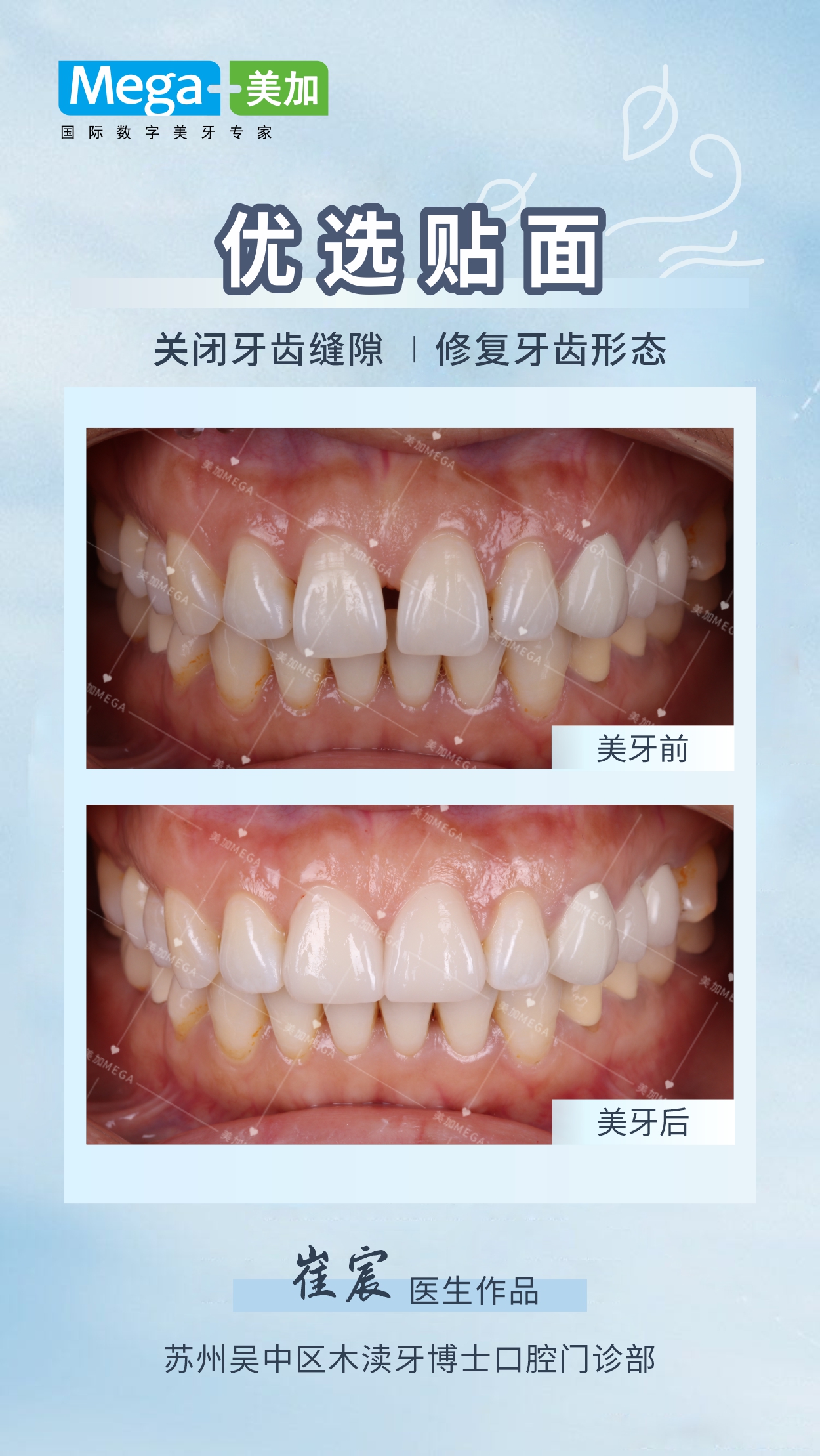 优选贴面- 关闭牙齿缝隙 |修复牙齿形态