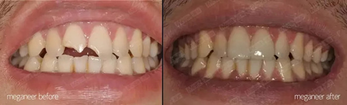 美加案例丨牙齿缺损，美加瓷贴面修复案例一则