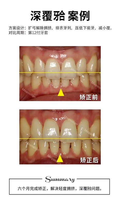 易齐微矫正案例集