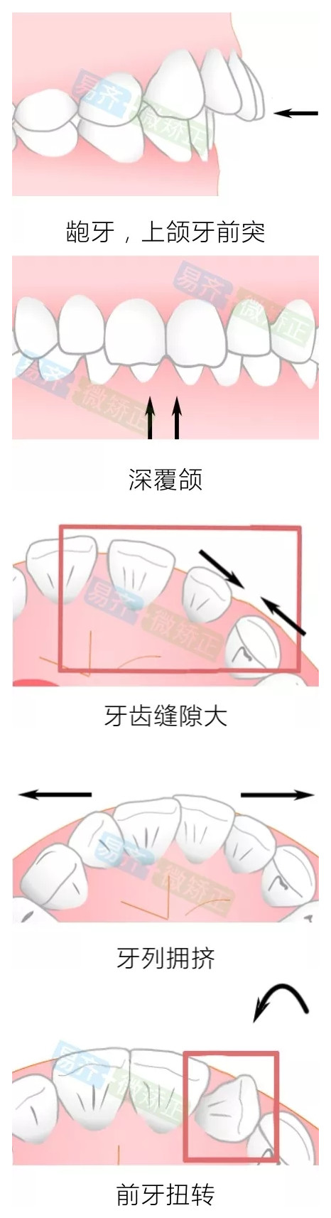 易齐矫正推出【微矫正】方案适应症