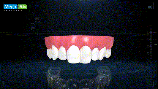 【易齐矫正】是一系列个性化定制的隐形矫正牙套