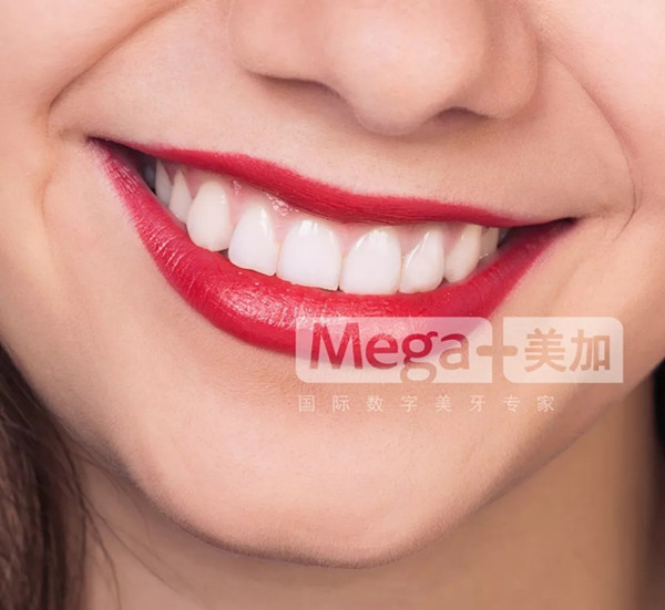 【隐形矫正篇】牙齿，对于女生来说有多重要？