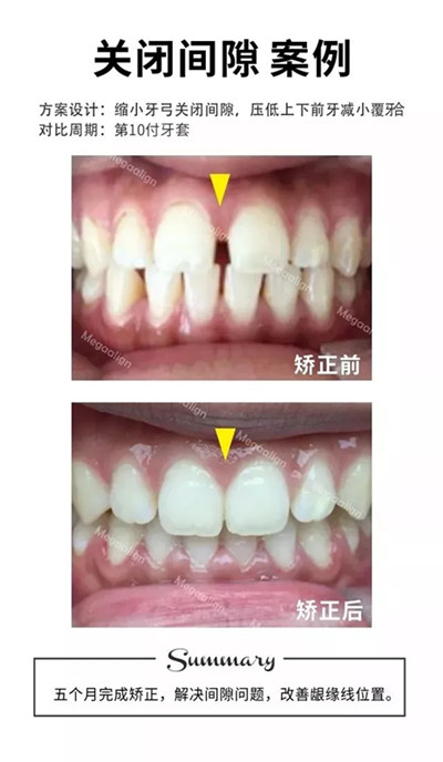 牙齿矫正-关闭间隙案例