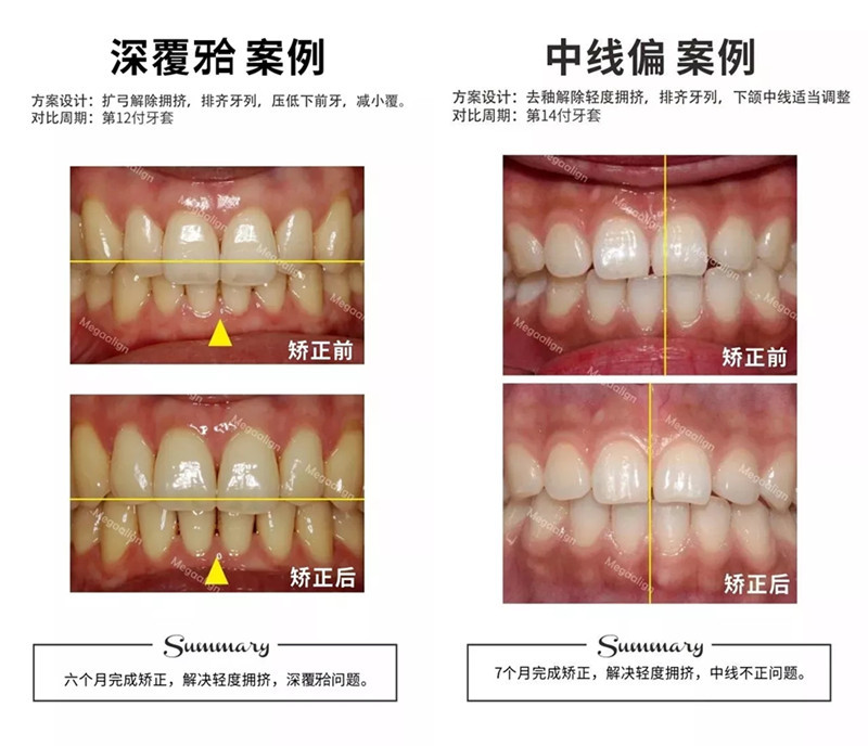 易齐微矫正·案例