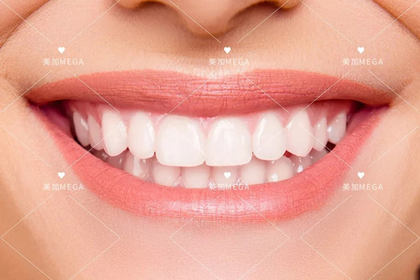 笑容99%的高级感都赢在这一点， 你的牙齿够美丽吗？