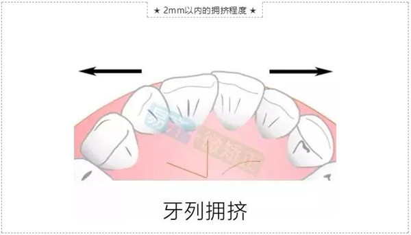 牙齿微矫适应症