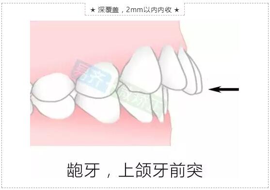 牙齿微矫适应症