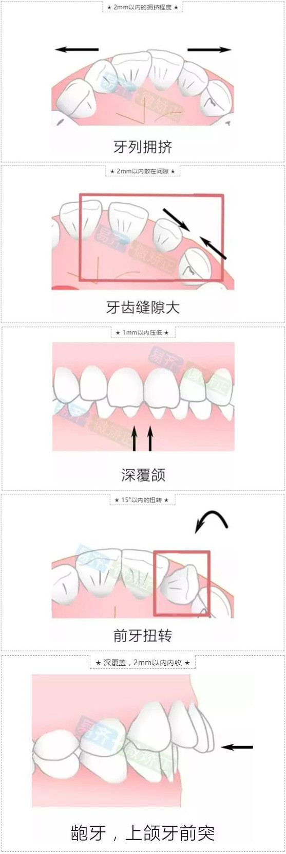 易齐微矫适应症