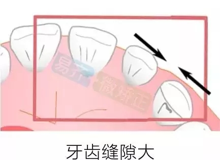 美加易齐微矫为您解决牙间隙问题