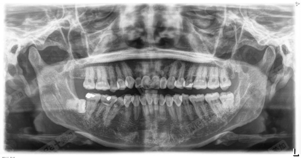 患者修复前口腔曲面断层片