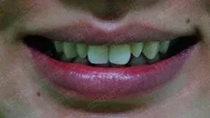 美加案例：瓷贴面关闭缝隙修复过小牙