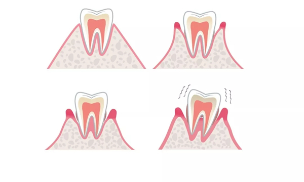 牙周病是牙齿松脱的主要原因