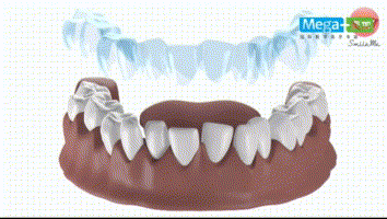 隐形矫正，牙齿酸痛怎么办？