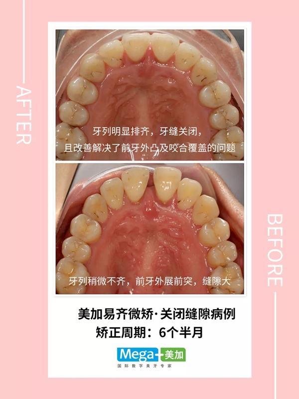 易齐微矫关闭牙缝隙案例