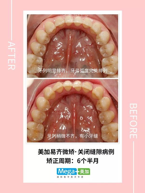 易齐微矫关闭牙缝隙案例