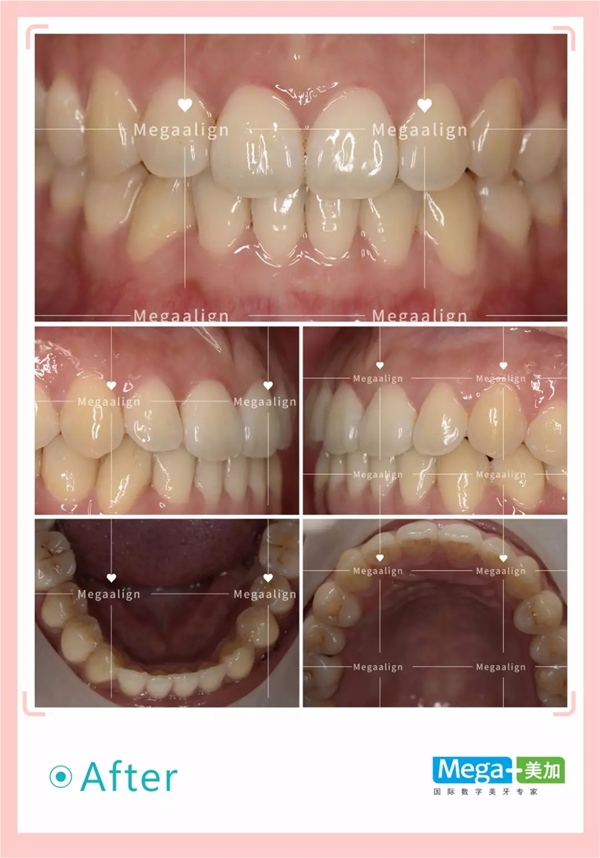 隐形矫正后口内照