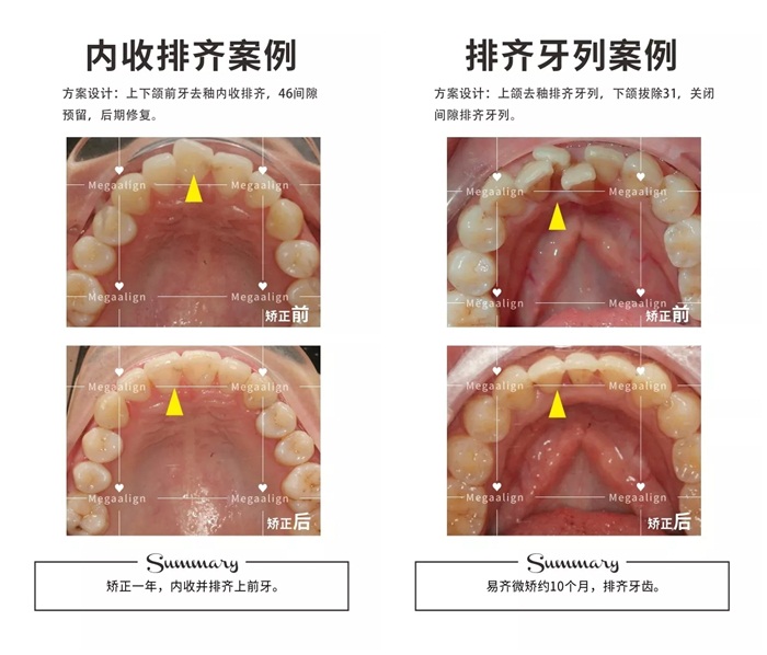 美加隐形矫正案例