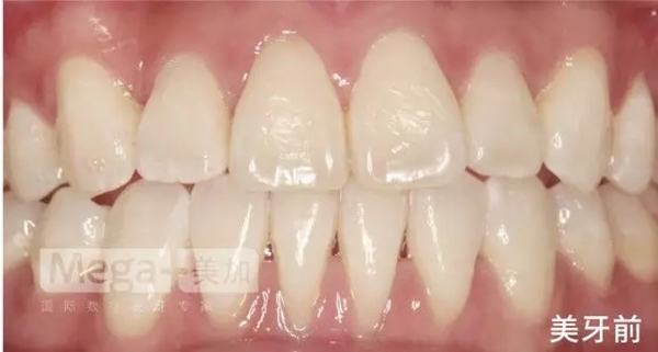 美加贴面案例丨为什么年龄越大牙齿就越黄？