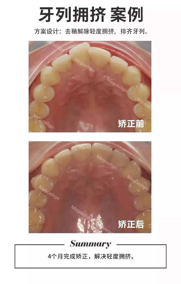 易齐微矫案例分享