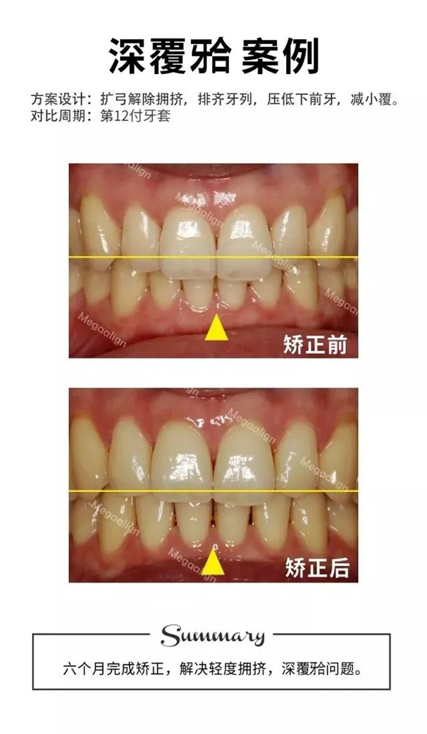 易齐微矫案例分享