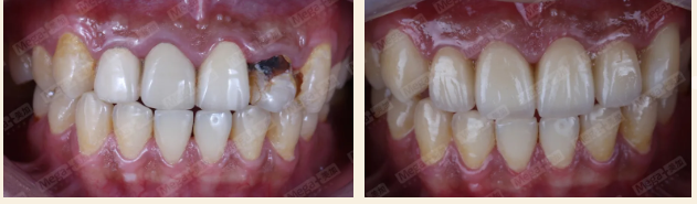 使用美加全瓷牙案例